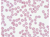 Schistocytes