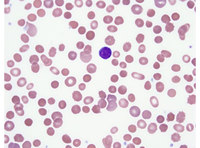 Spherocytes – hereditary spherocytosis