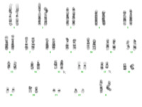 Acute promyelocytic leukemia, karyotype