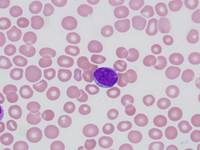Acute Myeloid Leukemia with t(9;11)(p22;q23)