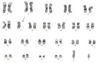 Cytogenetics Monosomy 7