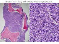 B-ALL-CD-34-negative-Marrow-biopsy