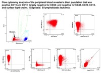B-ALL-CD-34-negative-Flow-Cytometry