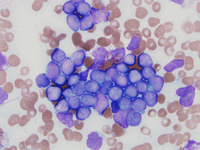 B-ALL-CD-34-negative-Aspirate