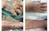 Cutaneous Plasmacytoma - 1