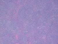 Mottled-atypical-lymphoid-nodules