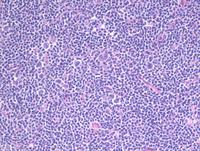 Nodules-with-scattered-larger-cells