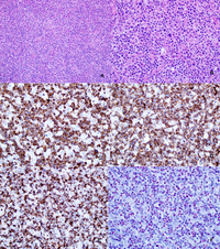 EBV-positive T-cell Lymphoproliferative Disorder