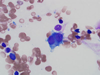 Refractory-Cytopenia-of-Childhood