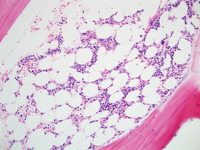 Refractory-Cytopenia-of-Childhood