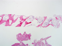 Refractory-Cytopenia-of-Childhood