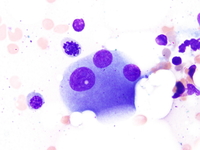 Refractory-cytopenia-of-childhood-GATA2-deficiency-related--Aspirate