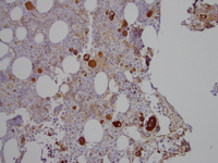 Refractory-cytopenia-of-childhood-GATA2-deficiency-related-Factor-VIIIvw-immunohistochemistry-stain