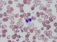 Refractory cytopenia of childhood, GATA2 deficiency related