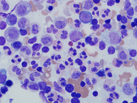 WHIM-Syndrome-aspirate