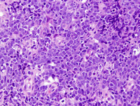Diffuse large B-cell lymphoma, Leg type 1