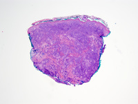 Diffuse large B-cell lymphoma, Leg type 2