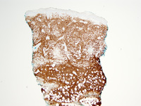 Diffuse large B-cell lymphoma, Leg type 3