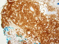 Diffuse large B-cell lymphoma, Leg type 4