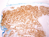 Diffuse large B-cell lymphoma, Leg type 5