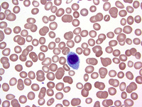 Hairy cell leukemia 1