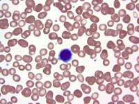 Hairy cell leukemia 3