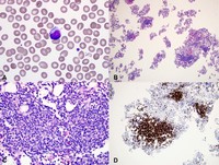 Tcell-large-granular-lymphocytic-leukemia