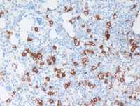T-cell histiocyte rich large B-cell lymphoma involving marrow