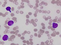 Hand mirror blastcells with t(8;21) and abberant expression of CD 19