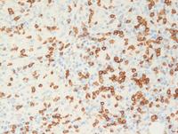 Lymphoepitheliod-cell-Lennerts-lymphoma