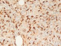 Lymphoepitheliod-cell-Lennerts-lymphoma