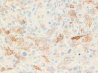 Lymphoepitheliod-cell-Lennerts-lymphoma