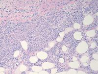 Lymphoepitheliod-cell-Lennerts-lymphoma