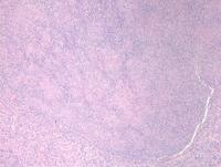 Lymphoepitheliod-cell-Lennerts-lymphoma