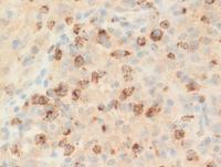 Lymphoepitheliod-cell-Lennerts-lymphoma