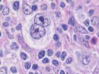 Reed Sternberg Cell