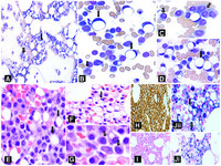 Signet ring plasma cell myeloma