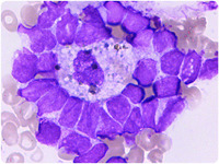 Blastic island in acute myeloid leukemia