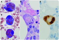 Cytomegalovirus-associated hemophagocytic lymphohistiocytosis in a patient with myasthenia gravis treated with azathioprine