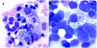 Hemophagocytic Lymphohistiocytosis and Disseminated Histoplasmosis