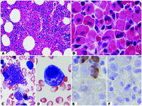 Crystal-storing histiocytosis with IgD κ–associated plasma cell neoplasm