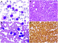 “Hairless” hairy cells