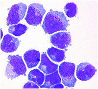 Acute myeloid leukemia relapse first presenting in the cerebrospinal fluid