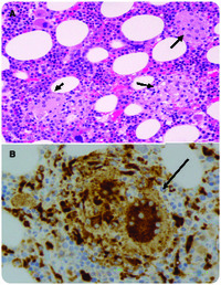 BCGitis induced inflammatory granuloma of the bone marrow