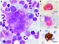 Giant multilobated mastocytes (promastocytes) in the setting of a refractory acute myeloid leukemia with myelodysplasia-related changes and monosomal