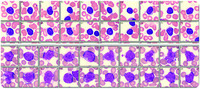 Digital imaging of peripheral blood identifies atypical chronic lymphocytic leukemia
