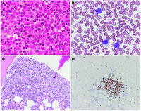 Spontaneous splenic rupture in mantle cell lymphoma with leukemic variant
