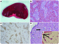 Hepatosplenic T-cell lymphoma