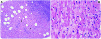 Unusual breast mass: lymphoma with crystal-storing histiocytosis