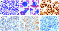 Neoplastic plasma cells mimic mature neutrophils in plasma cell myeloma with t(11;14)(q13;q32)